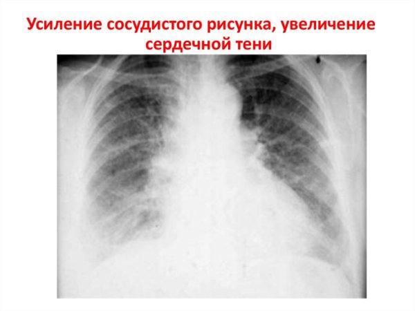Усиление сосудистого рисунка легкого