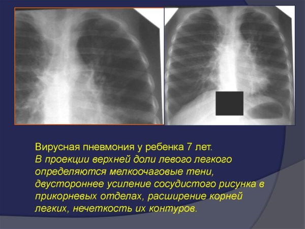 Усиление легочного рисунка на рентгене