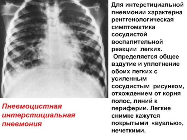 Усиление лёгочного рисунка на рентгенограмме