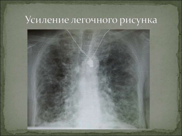 Глобальный гипокинез