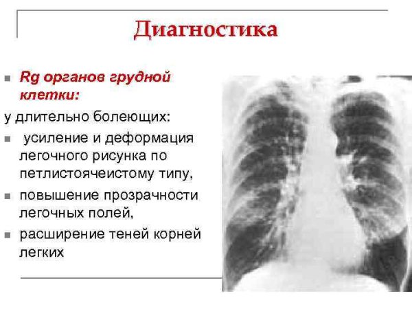 Усиление легочного рисунка