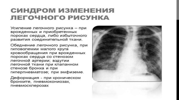 Рентгенограммы органов грудной клетки пневмония