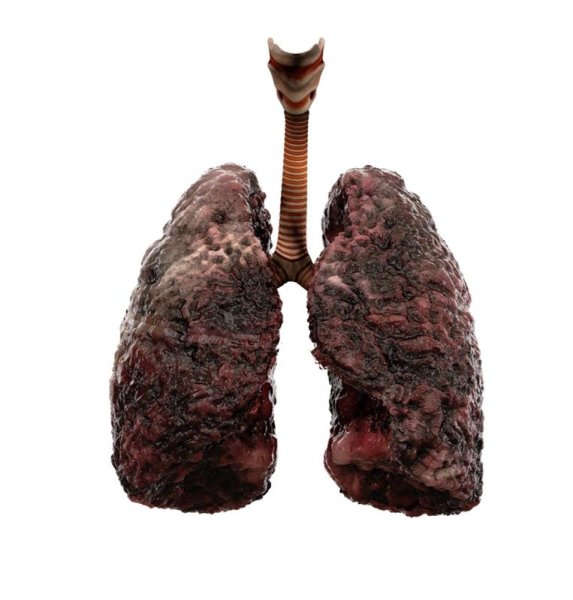 Легкие курильщика и здорового человека