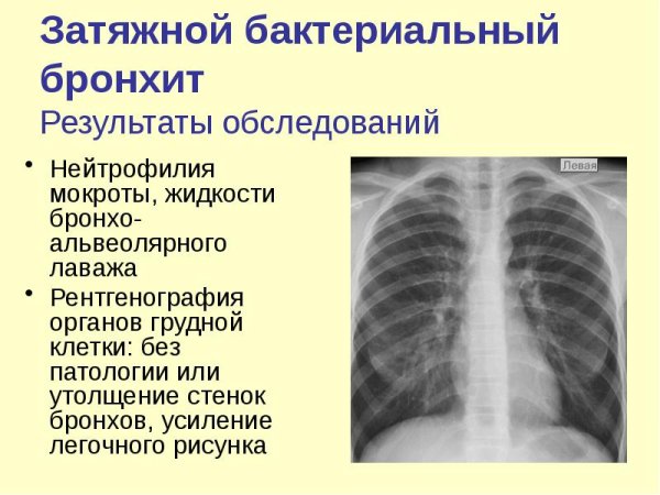 Рентген при обструктивном бронхите