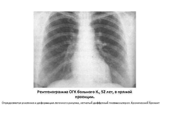 Усиление и деформация легочного рисунка