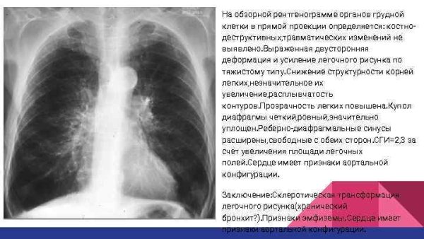 Пневмокониоз легких 1 стадия рентген