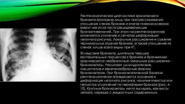 Усиление сосудистого рисунка