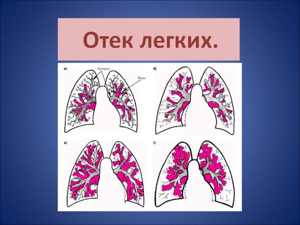 Нормальные легкие и отек легких