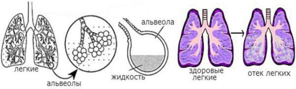 Жидкость в альвеолах легких