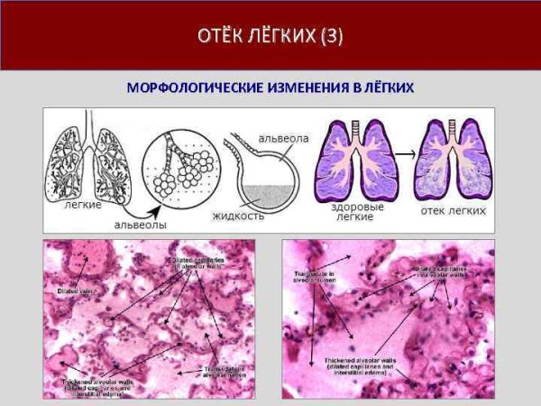 Отек легких микропрепарат патанатомия