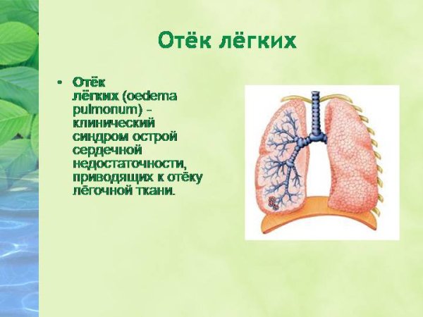 Альвеолярный отёк лёгких рентген