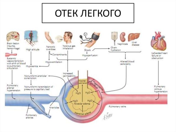 Положение пациента при отёке лёгких