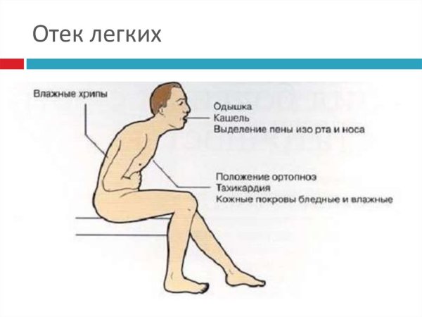 Отек легких развивается при