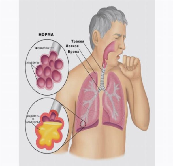 Некардиогенный отек легких рентген