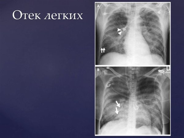 Положение больного при отёке лёгких
