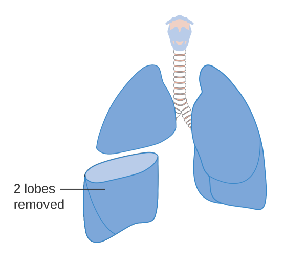 Верхняя лобэктомия легкого