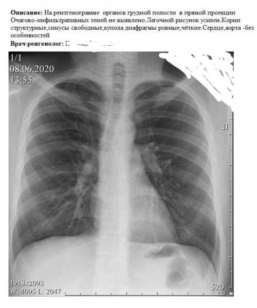Усиление легочного рисунка на рентгене