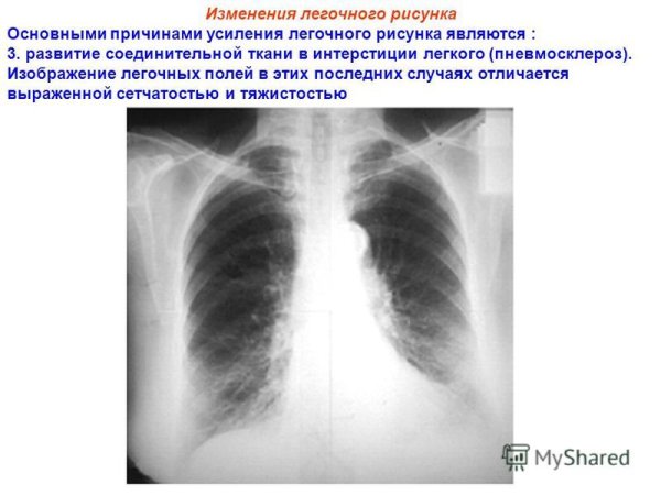 Синдром обогащения легочного рисунка рентген