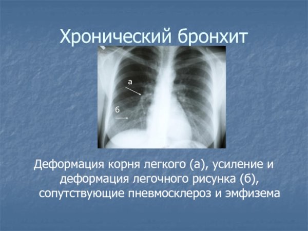 Рентген ОГК при хроническом бронхите