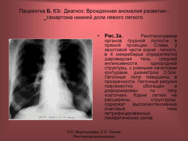 Линии Керли на рентгенограмме в легком