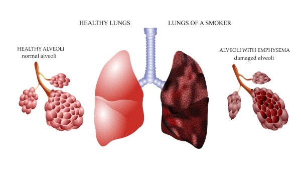 Лёгкие здорового человека и курильщика