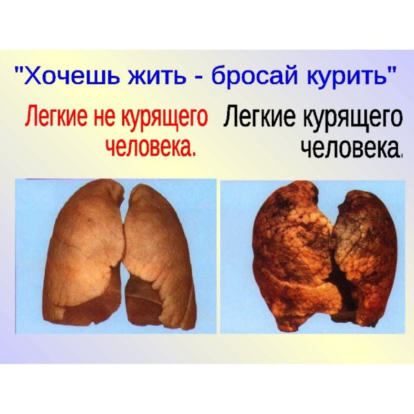 Лёгкие здорового человека и курильщика