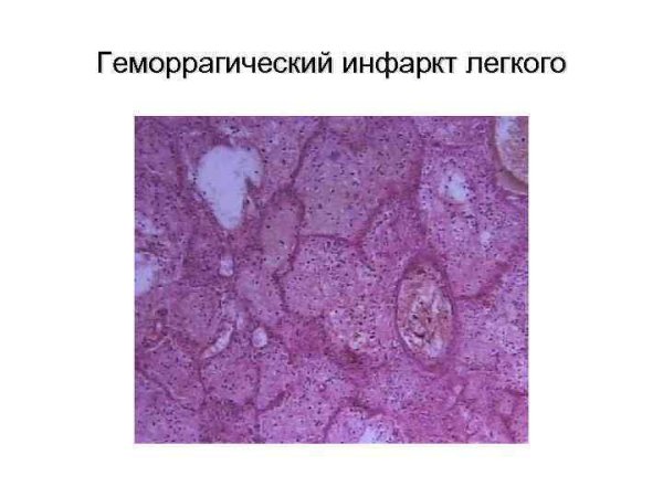 Геморрагический инфаркт легкого гематоксилин эозин