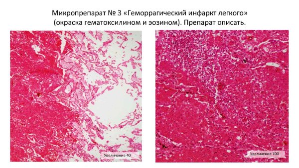 Красный инфаркт легкого микропрепарат