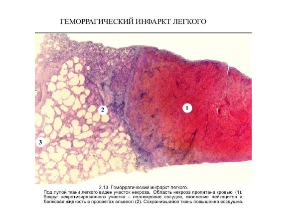Геморрагический инфаркт легкого макропрепарат описание