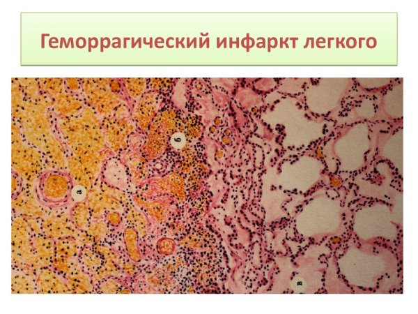 Анемический инфаркт почки микропрепарат рисунок