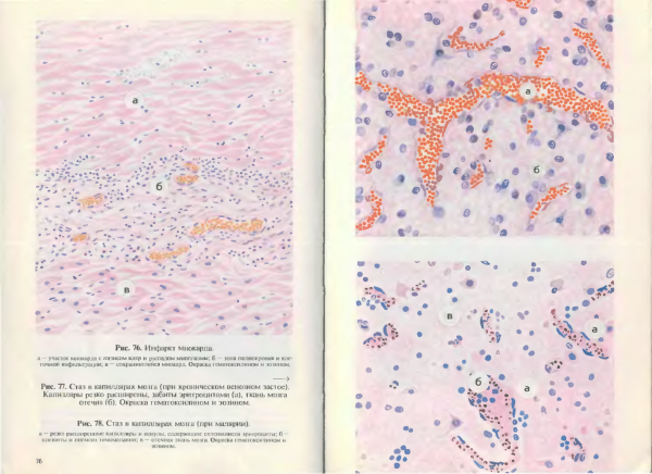 Геморрагический инфаркт легкого окраска гематоксилином