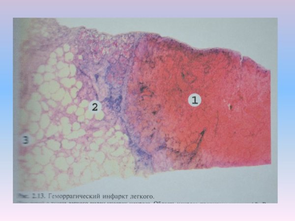 Геморрагический инфаркт патанатомия