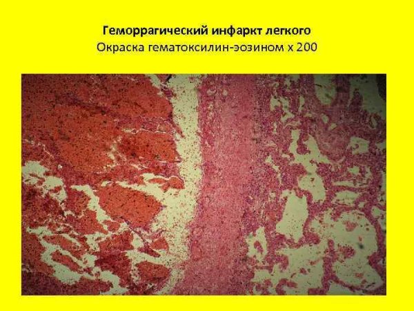 Геморрагический инфаркт легкого гистология