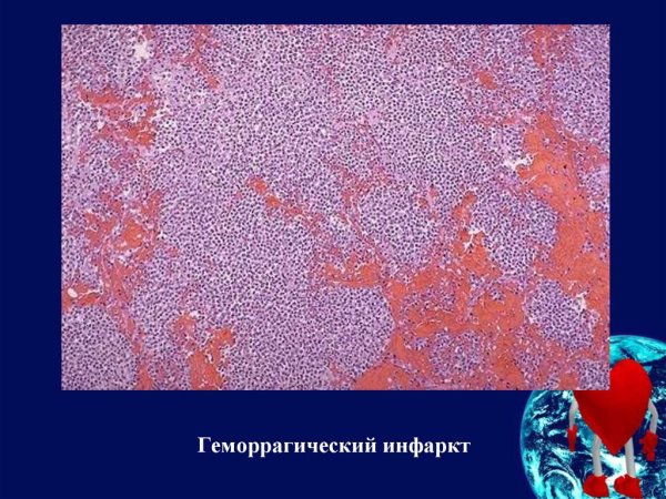 Красный геморрагический инфаркт легкого