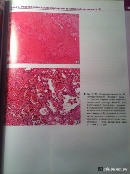 Красный геморрагический инфаркт