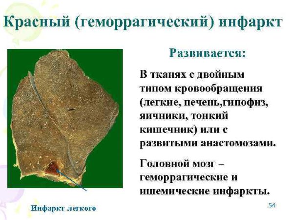 Красный инфаркт легкого микропрепарат