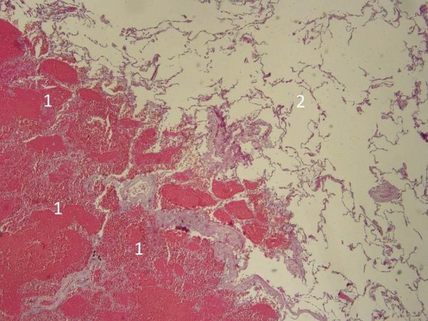 Геморрагический инфаркт патанатомия