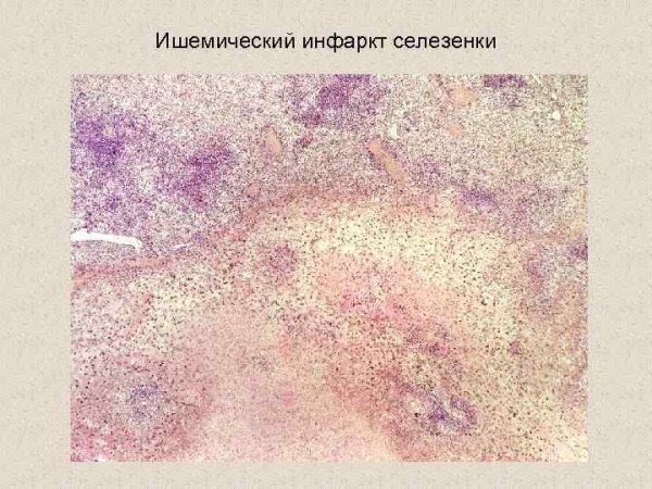 Артериальное полнокровие патологическая анатомия