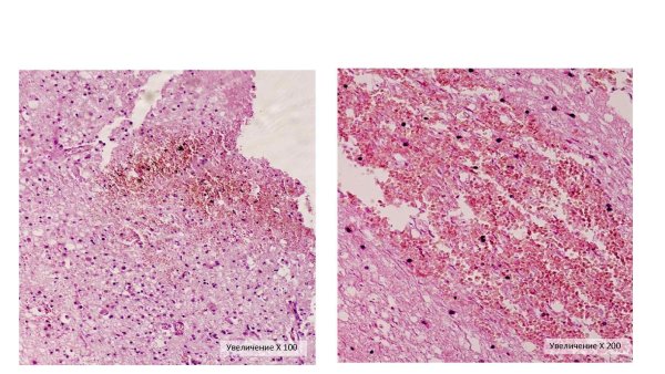 Инфаркт почки с зоной демаркационного воспаления