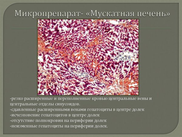 Геморрагический инфаркт макропрепарат