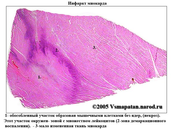 Геморрагический инфаркт легкого микропрепарат