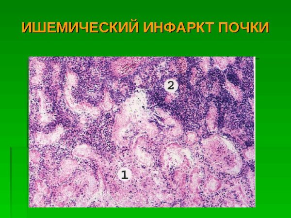 Ишемический инфаркт микропрепарат