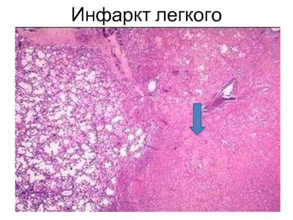 Бурая индурация легких патологическая анатомия