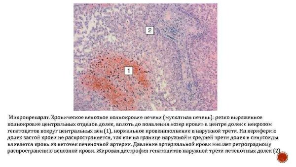 Ишемический инфаркт почки гематоксилин и эозин