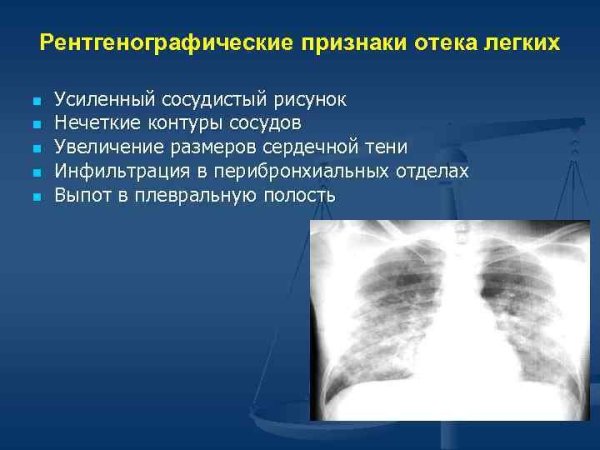 Нормальный легочный рисунок