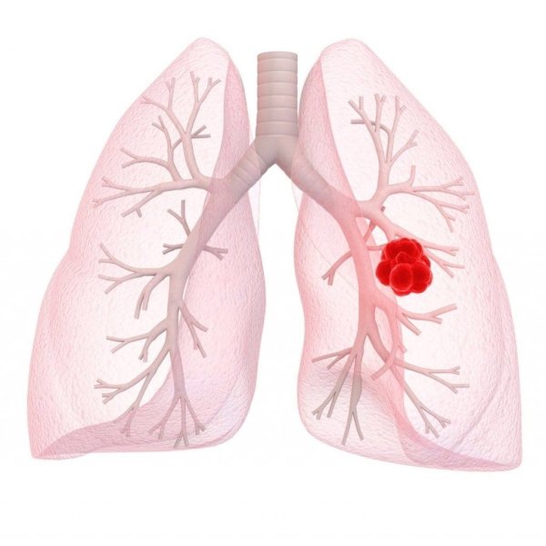 Бронхогенная карцинома легкого