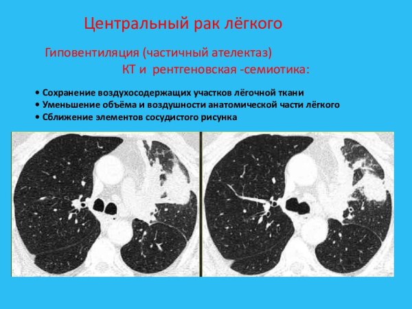 Периферическая опухоль верхней доли правого легкого кт