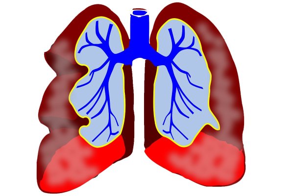 Всемирный день борьбы с пневмонией