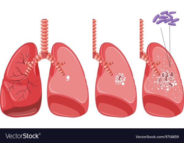 Легкие курящего человека