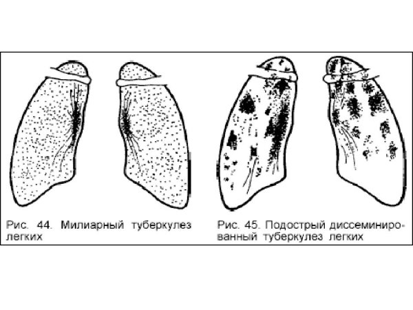 Острый милиарный туберкулез